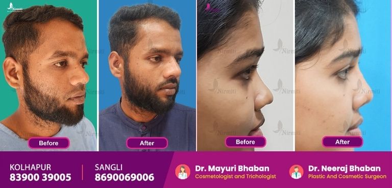 Rhinoplasty Surgeon in Kolhapur