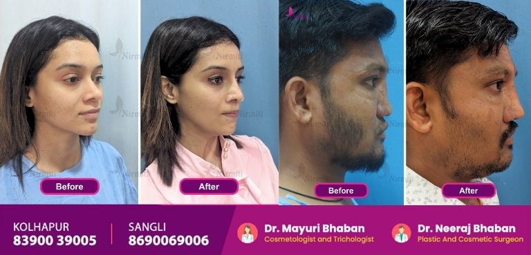 Rhinoplasty Surgeon