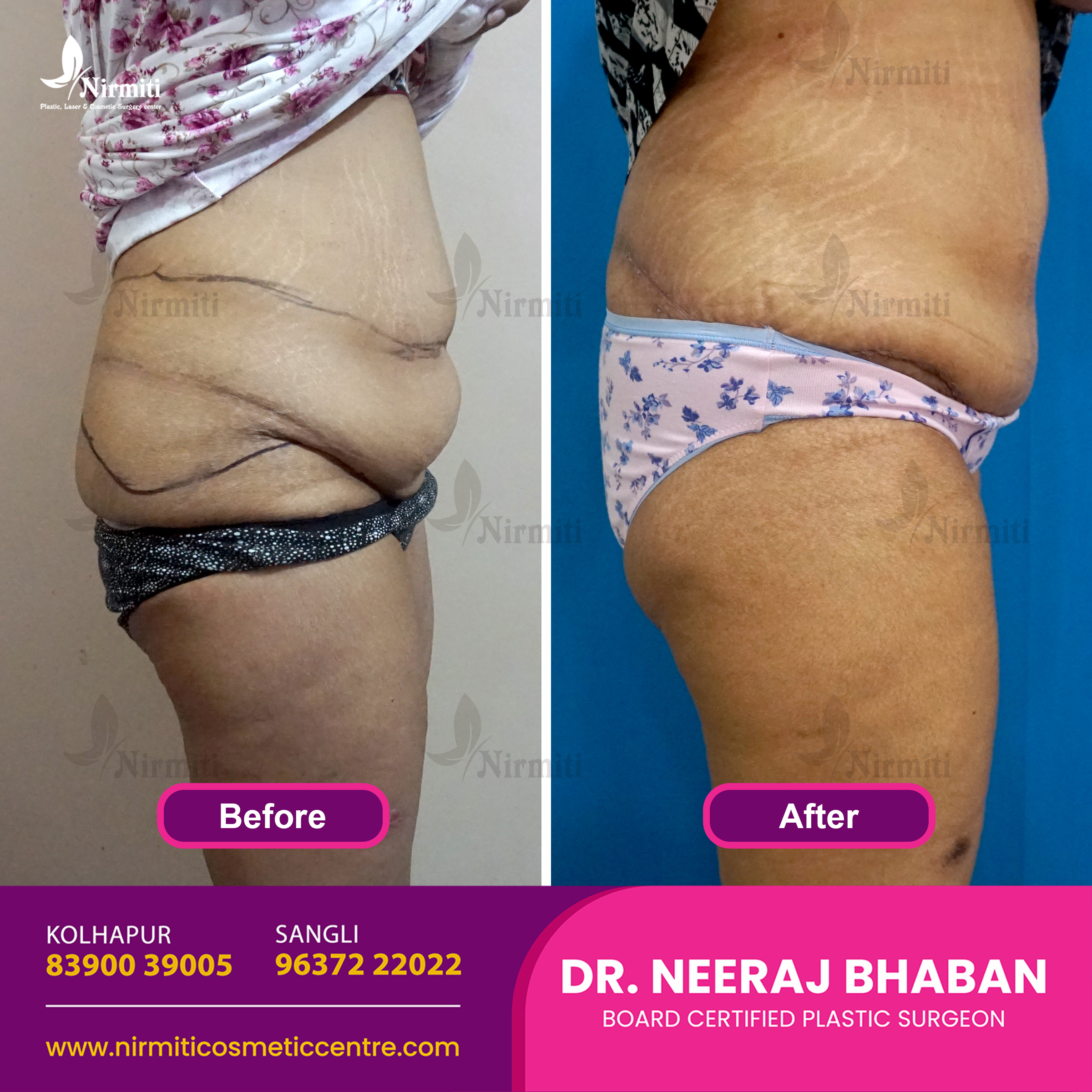 Body Fat Removal Treatment