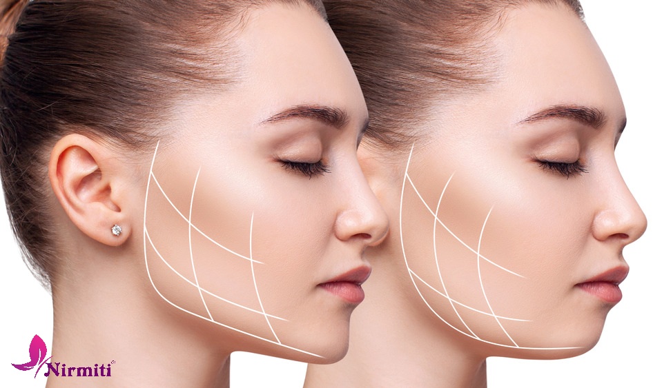 Buccal Fat Removal