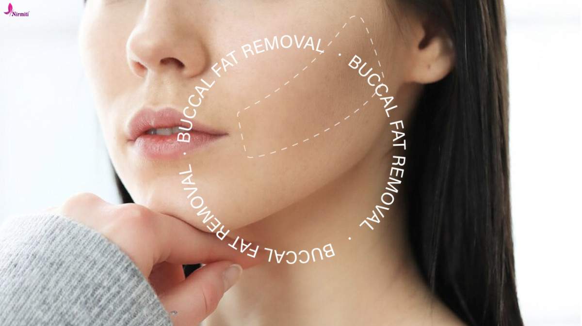 Cheek Fat Reduction