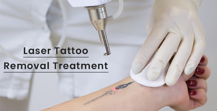 Laser Tatoo Removal Treatment