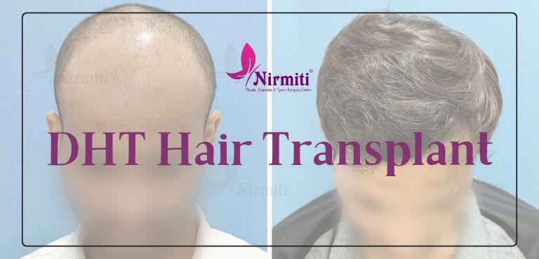 DHT Hair Transplant