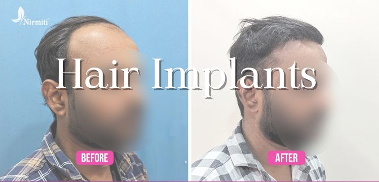 Hair Implants