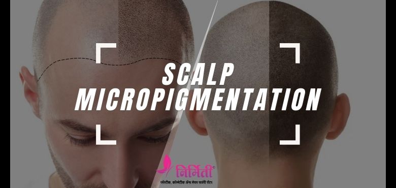 Scalp Micropigmentation