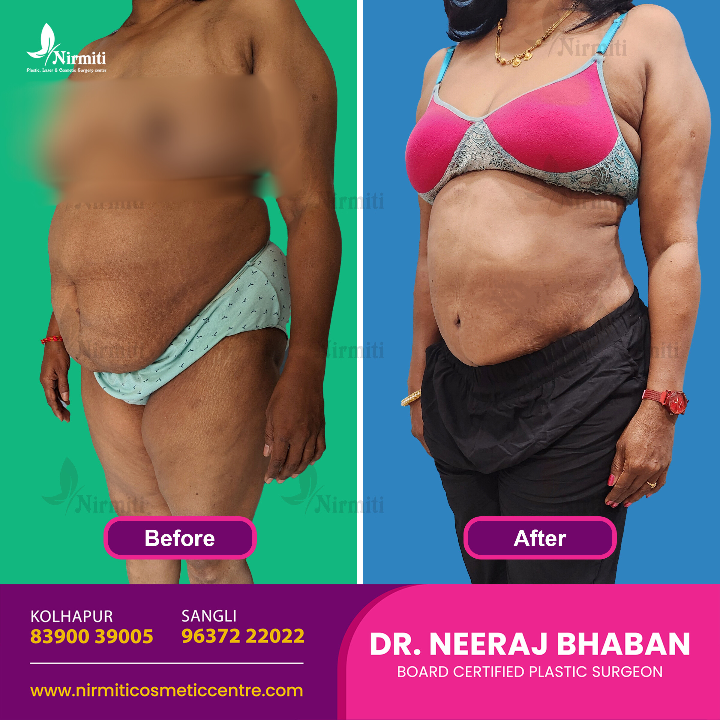 Abdominoplasty Surgery