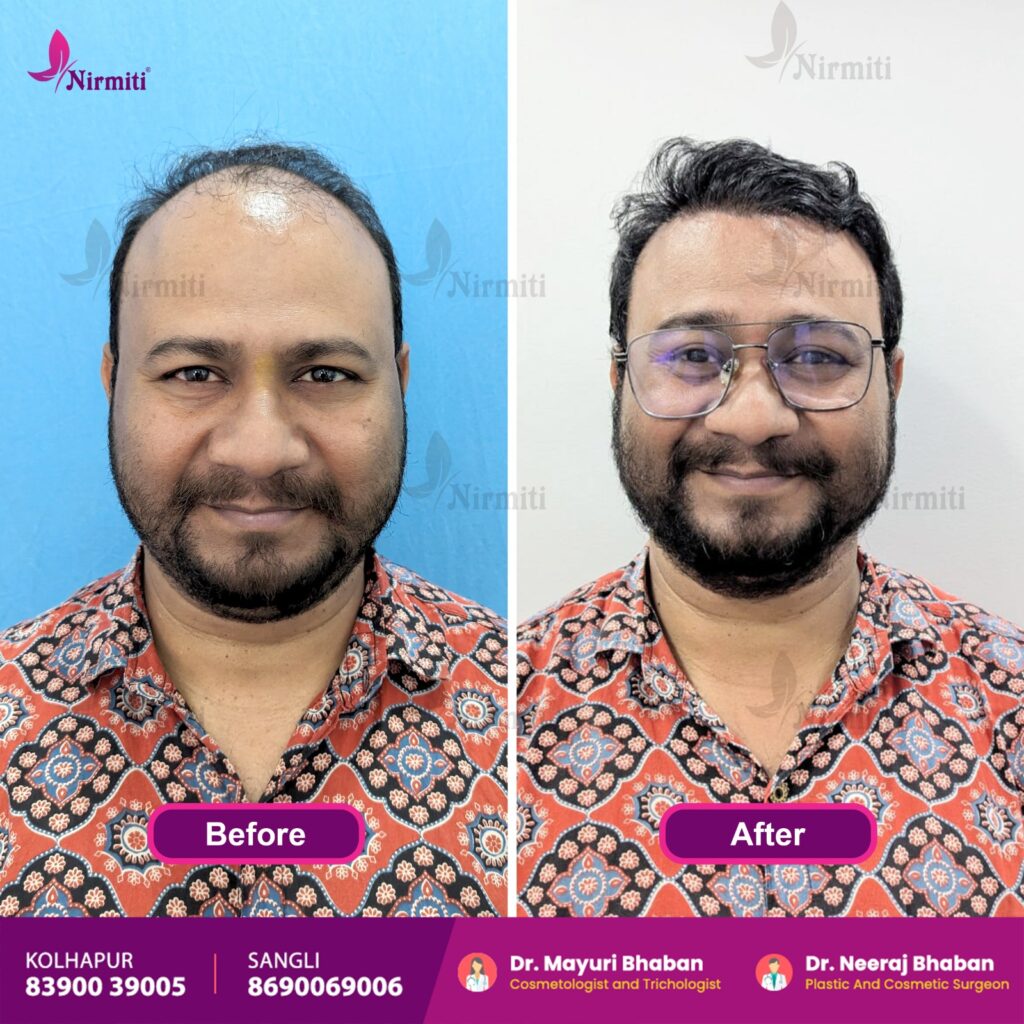 Best Hair Transplant