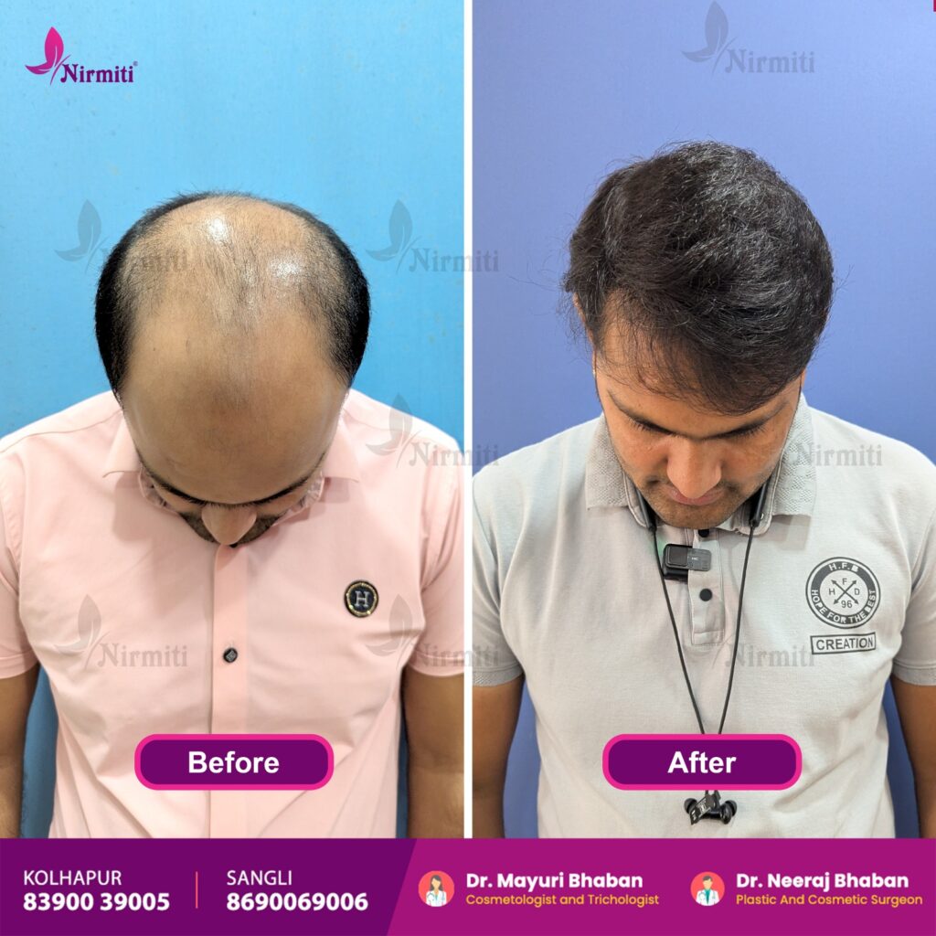 DHT Hair Transplant