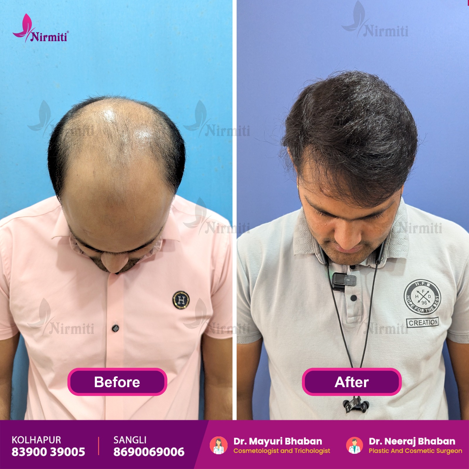 DHT Hair Transplant