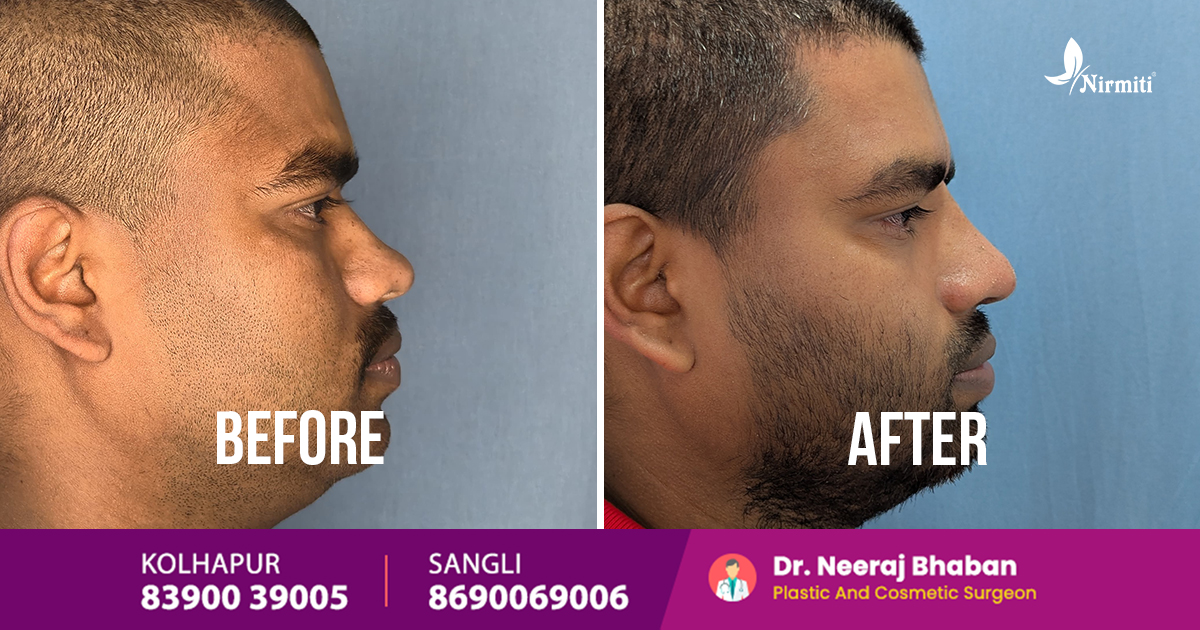 Rhinoplasty