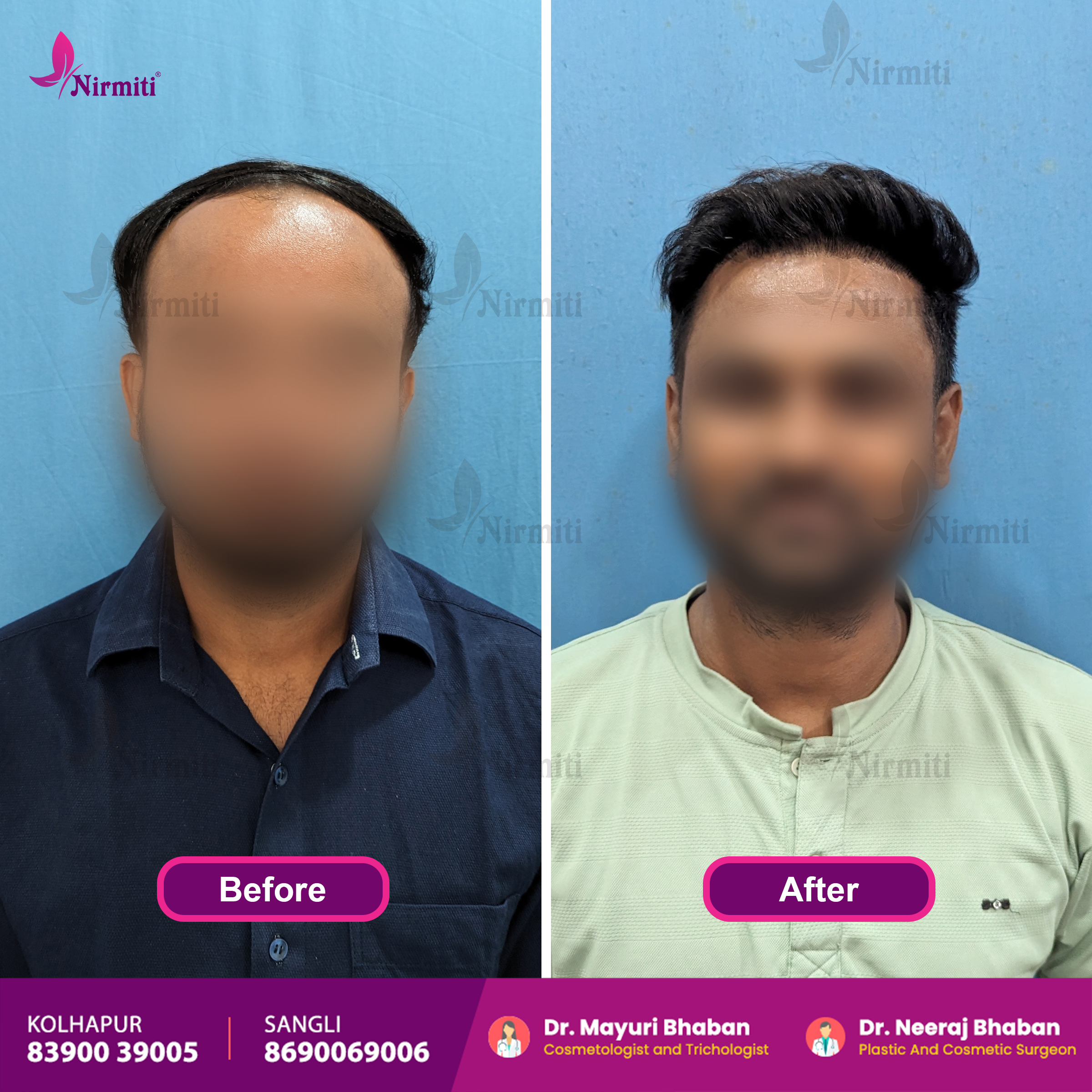 hair transplantation
