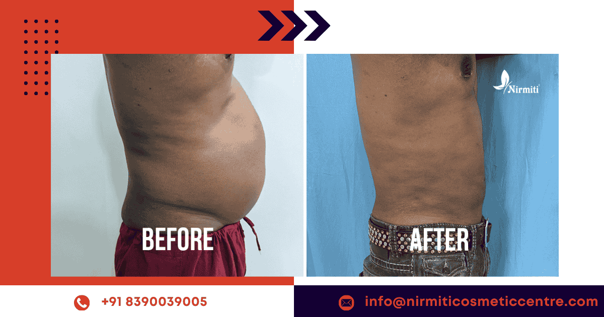 liposuction surgery