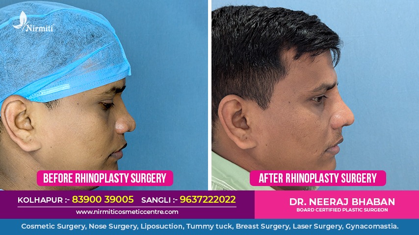 rhinoplasty