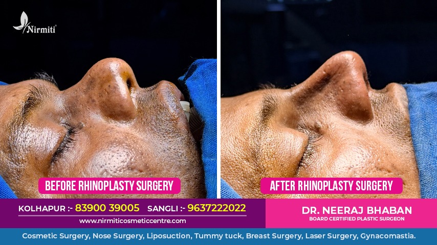 Rhinoplasty