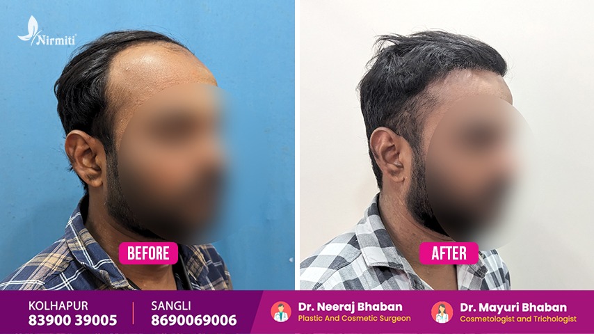 Hair Transplant