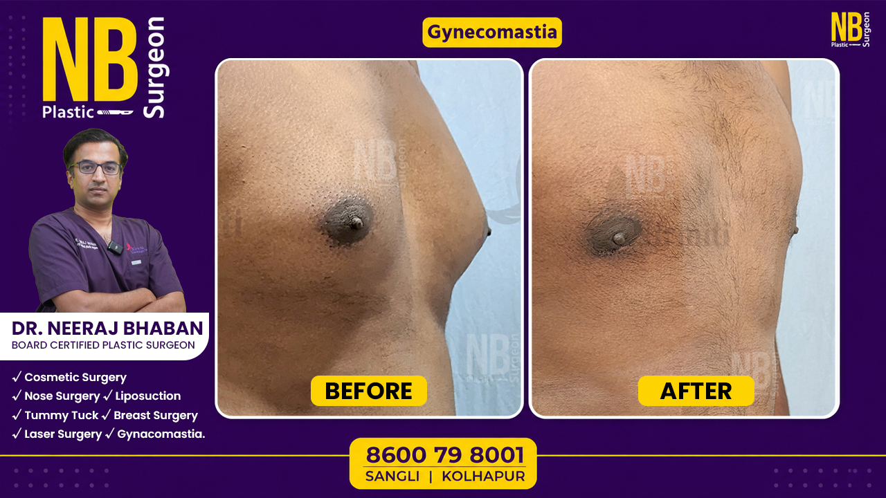 Gynecomastia-3.jpg Gynecomastia-3.jpg