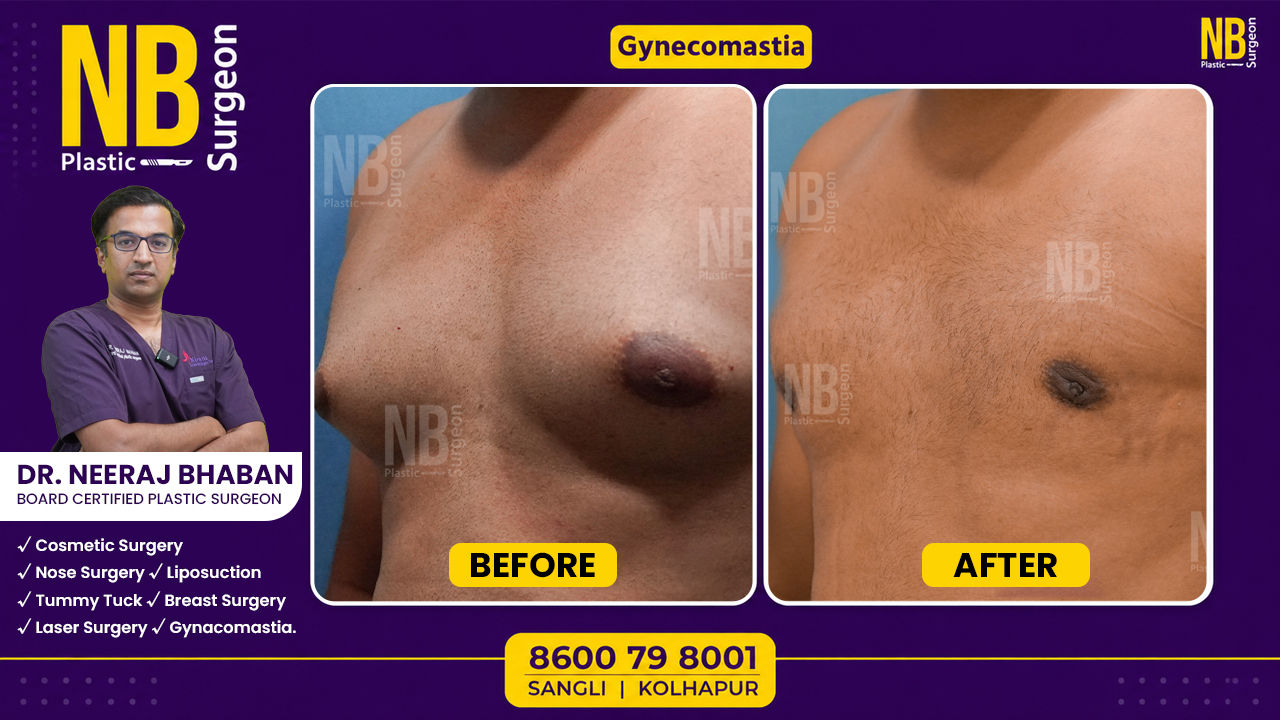 Gynecomastia.jpg Gynecomastia.jpg