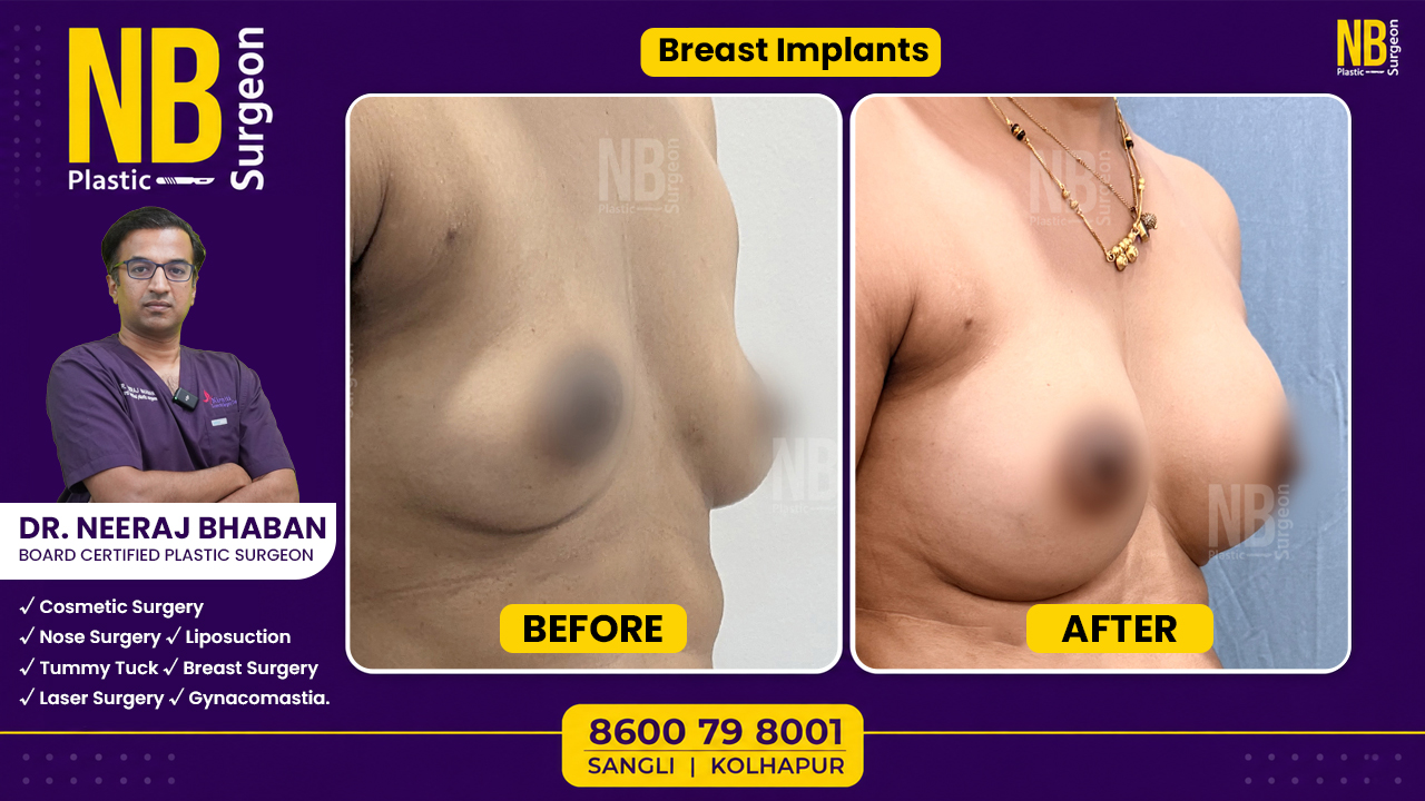 breast-implant-1.jpg breast-implant-1.jpg