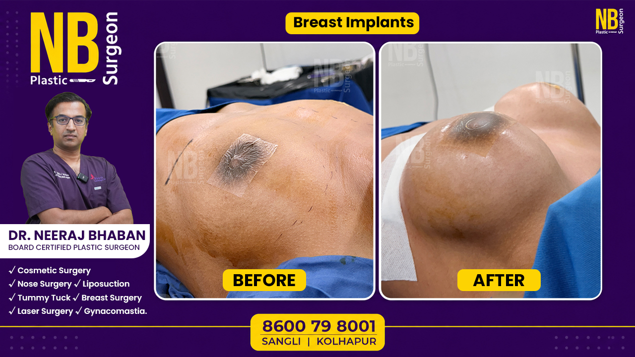 breast-implant-2.jpg breast-implant-2.jpg