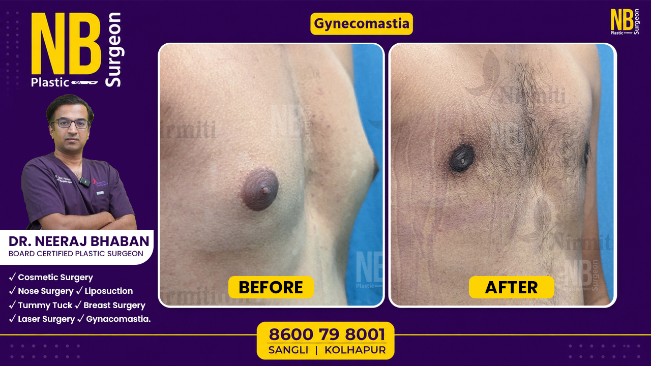 gynecomastia-1.jpg gynecomastia-1.jpg
