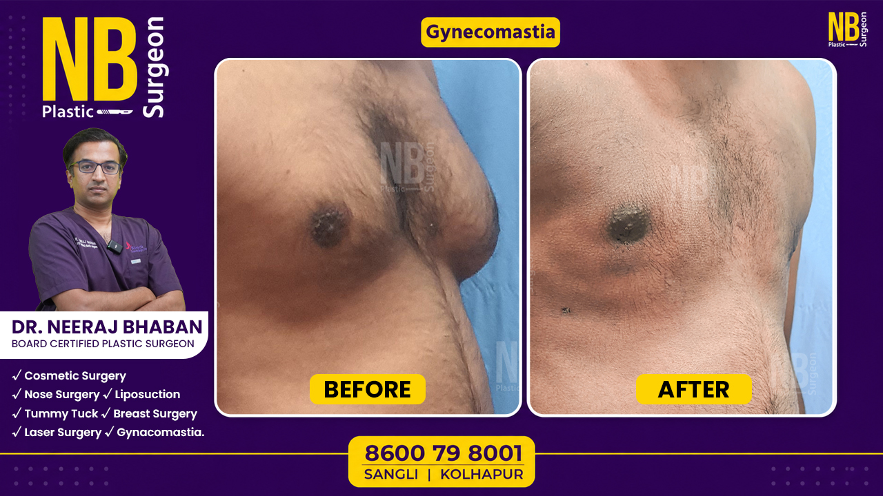 gynecomastia-2.jpg gynecomastia-2.jpg