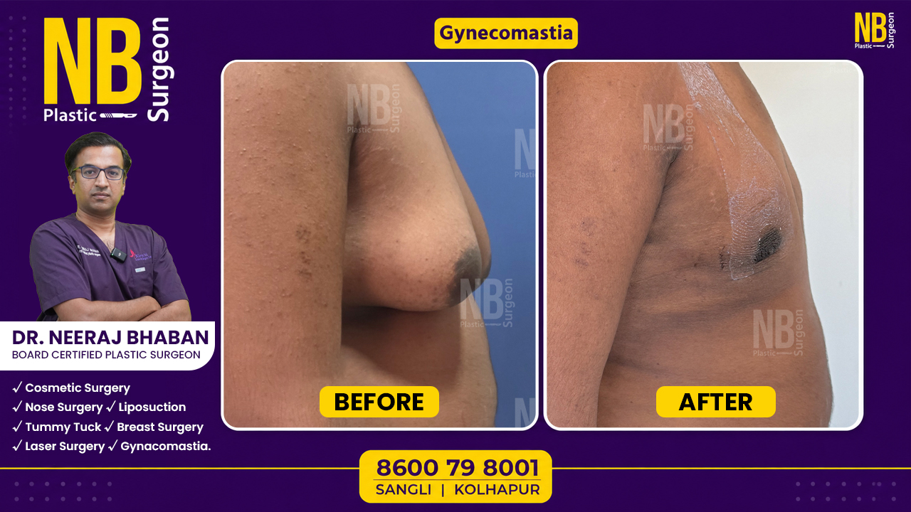 gynecomastia-4.jpg gynecomastia-4.jpg