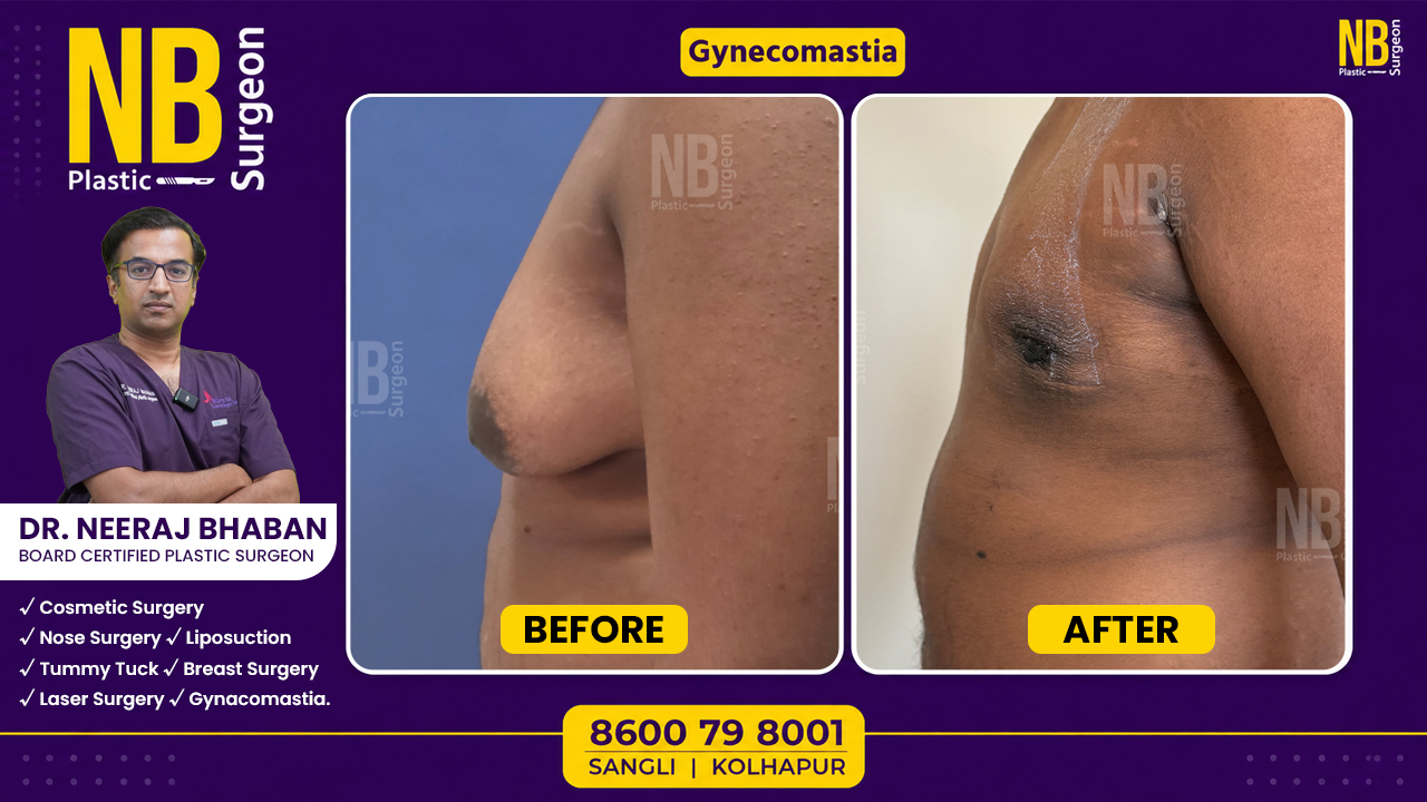 gynecomastia-5.jpg gynecomastia-5.jpg