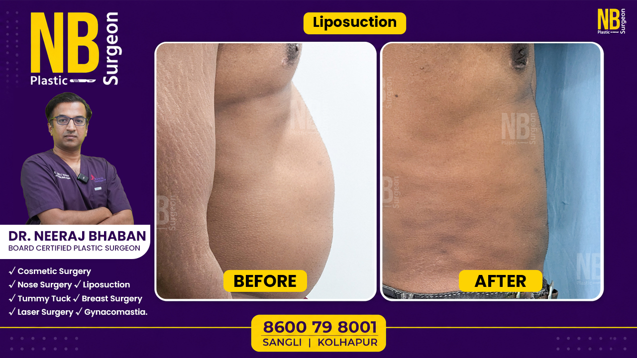 liposuction
