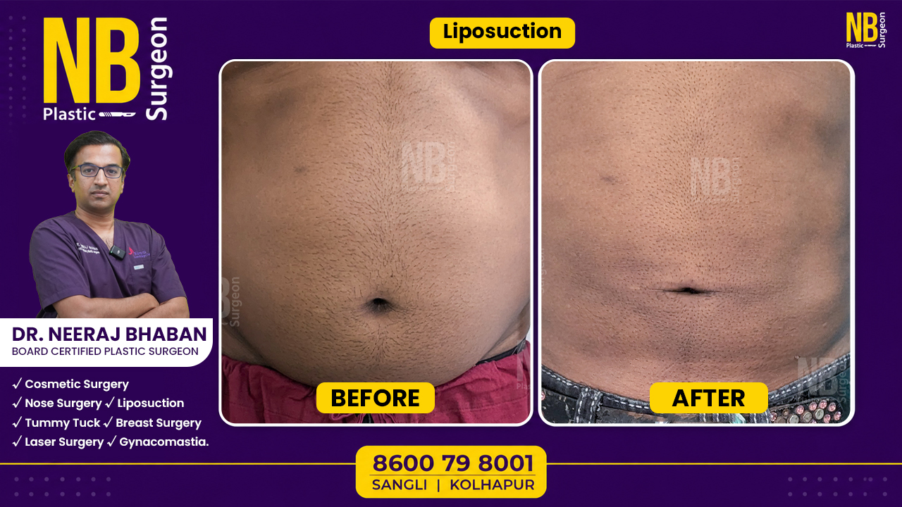 liposuction-2.jpg