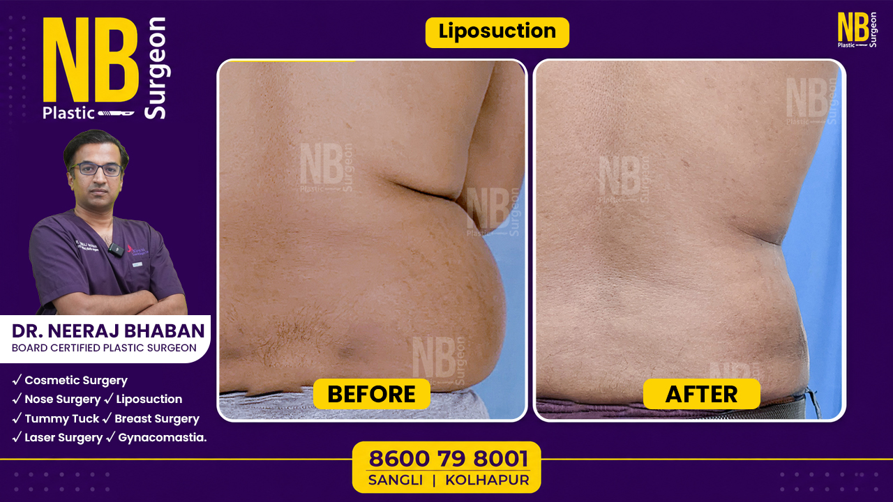 liposuction-3.jpg