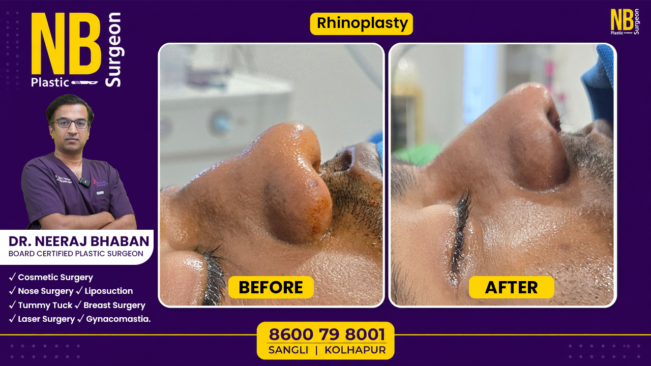 rhinoplasty