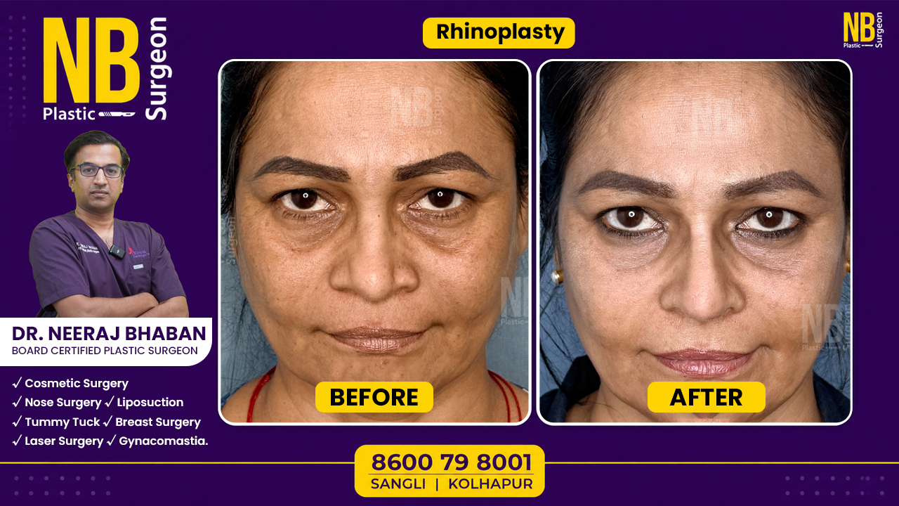 rhinoplasty
