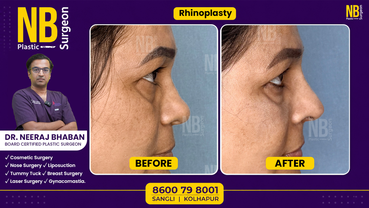 rhinoplasty