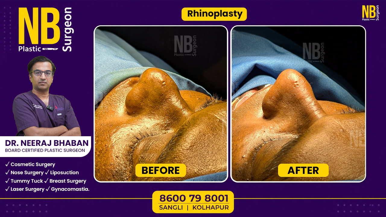 rhinoplasty